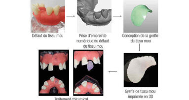 Approche de l’impression 3D en dentisterie