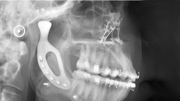 Chirurgen plaatsen 3D-geprint titanium kaakgewricht