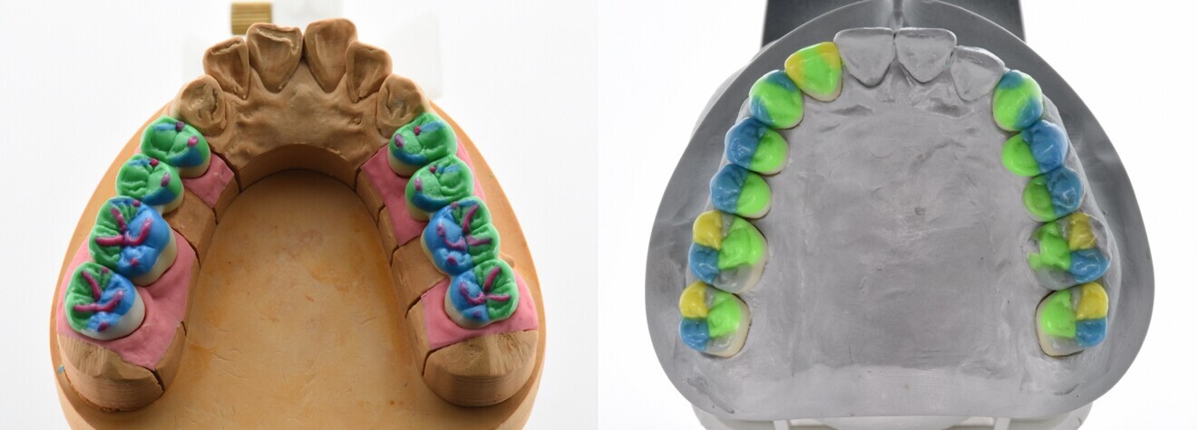 Figs. 1a & b: Natural waxing-up technique (a) by dental technician Dieter Schulz and sequential functional occlusion (b) by Prof. Rudolf Slavicek.