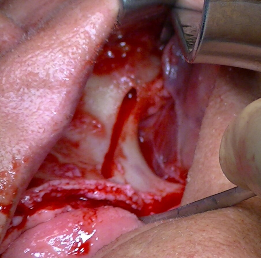 Fig. 5b - Preparazione ultimata.