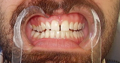 Cierre Digital de Diastema