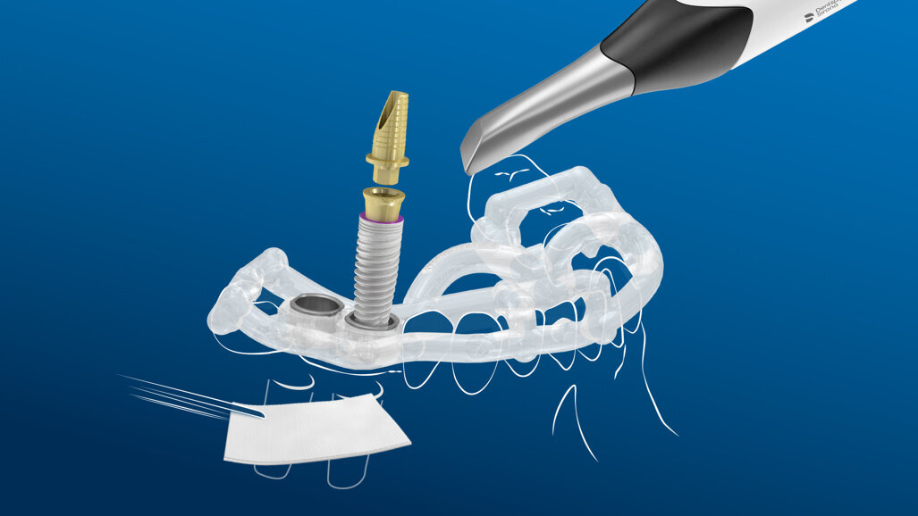 Making implantology simple with the MIS digital workflow