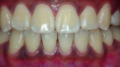 Non-ablative melanin depigmentation of gingiva