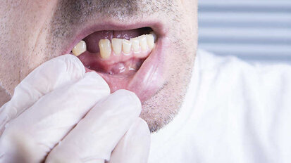 FDI objavila nove smernice za tretman pacijenata sa parcijalnom denticijom