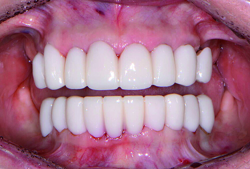 Fig. 8: Upper and lower provisional restorations.