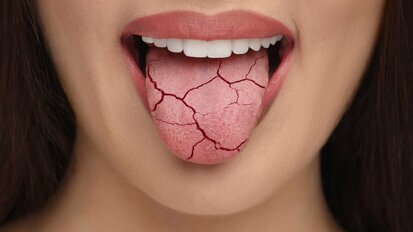 Neues Material zur Linderung bei Mundtrockenheit