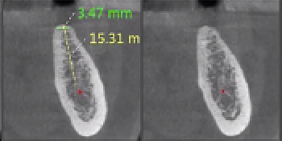 Fig. 26 : Zone édentée trop étroite, inadaptée à une pose d’implant. 