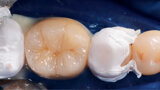 Fig. 8. Colocación de la corona.