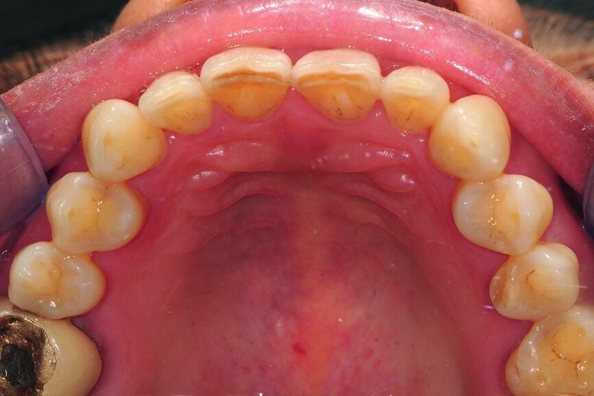 Fig. 8: Upper jaw view pre-operation.