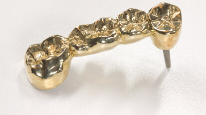 Gold für Dentallegierungen weniger gefragt