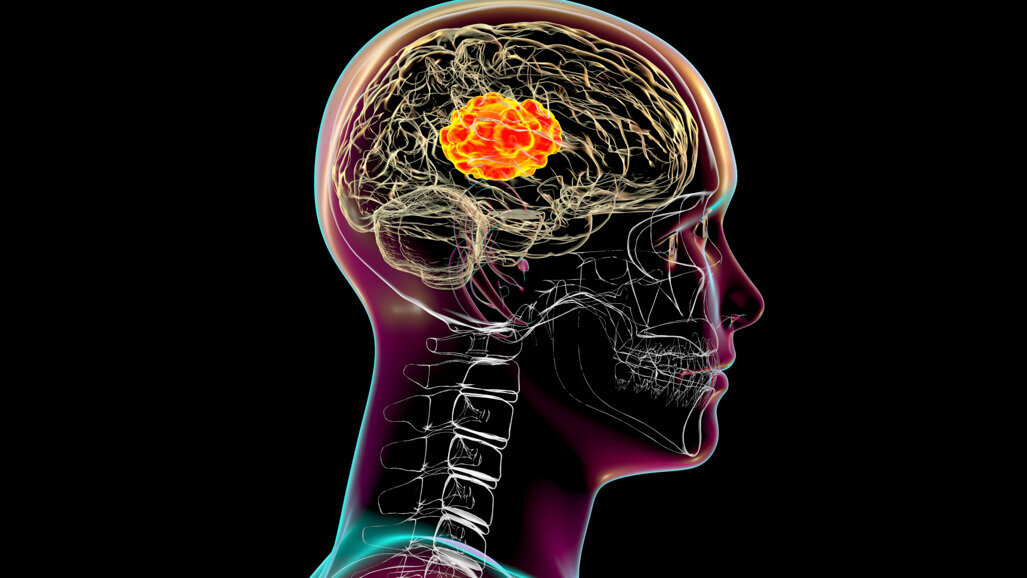 Oral bacteria may give rise to brain abscesses, study shows