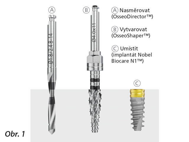 Ve většině případů zahrnuje preparace lůžka implantátu při použití systému implantátů N1 pouze dva chirurgické kroky: vytvoření hloubky a sklonu osteotomie pomocí OsseoDirector a poté vytvarování osteotomie pomocí OsseoShaper. Nástroj OsseoShaper vytváří prostor pro implantát, který odráží makrodesign implantátu N1.