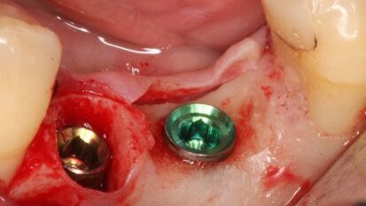 Verticale reconstructie van peri-implantaire zachte weefsels