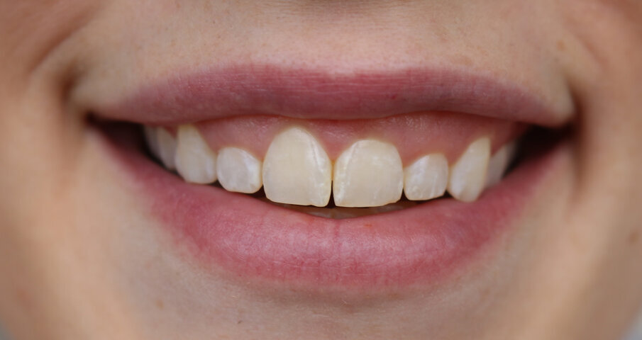 Fig. 2: Photograph showing the natural posed smile. The gingival margin was low and uneven.