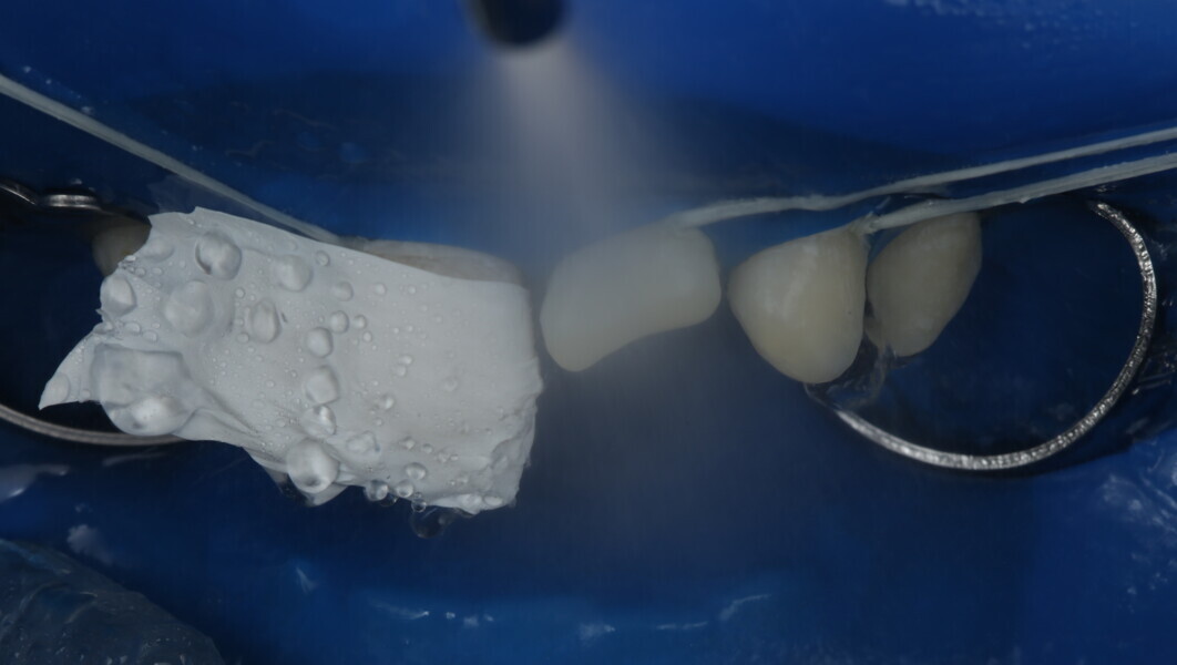 Fig 12: After thoroughly rinsing for 20 seconds the tooth was dried completely.