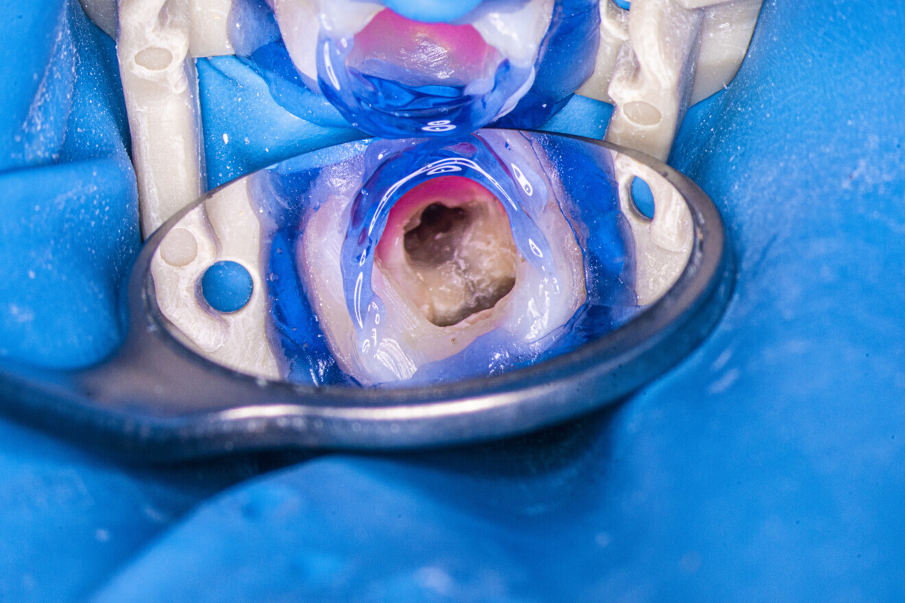 Fig. 6: Tooth after removal of the caries and sealing of the chamber with flowable composite and dental dam.