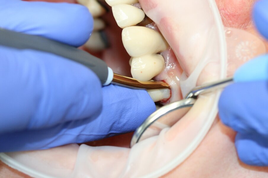 Fig. 4: The tooth was luxated with Luxator P4 (dual edge, lilac). 