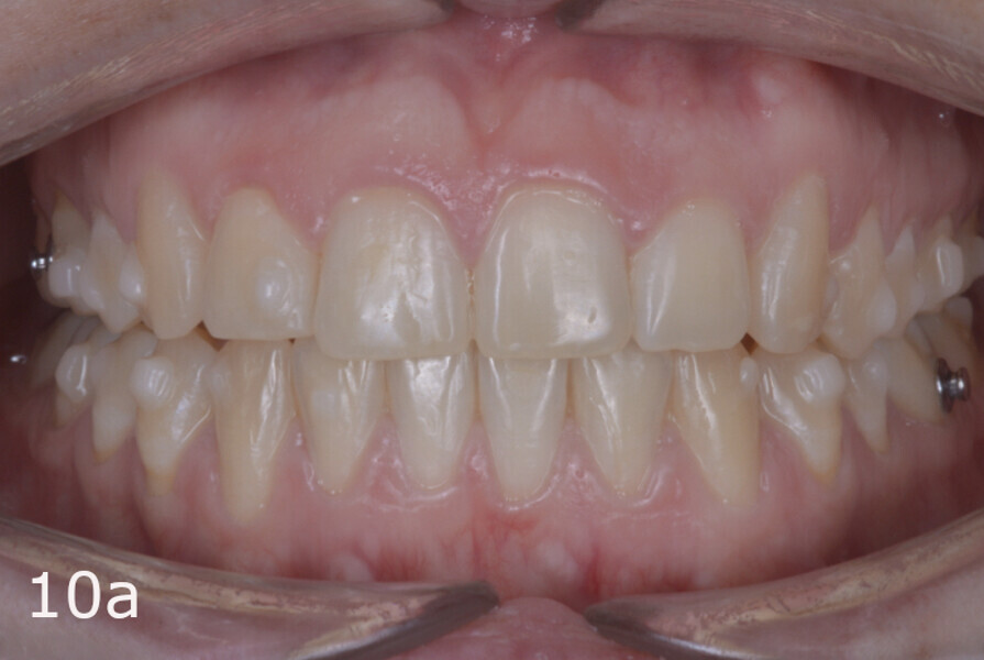 Figs. 10a–f: Situation after aligner set 63 prior to refinement aligners.