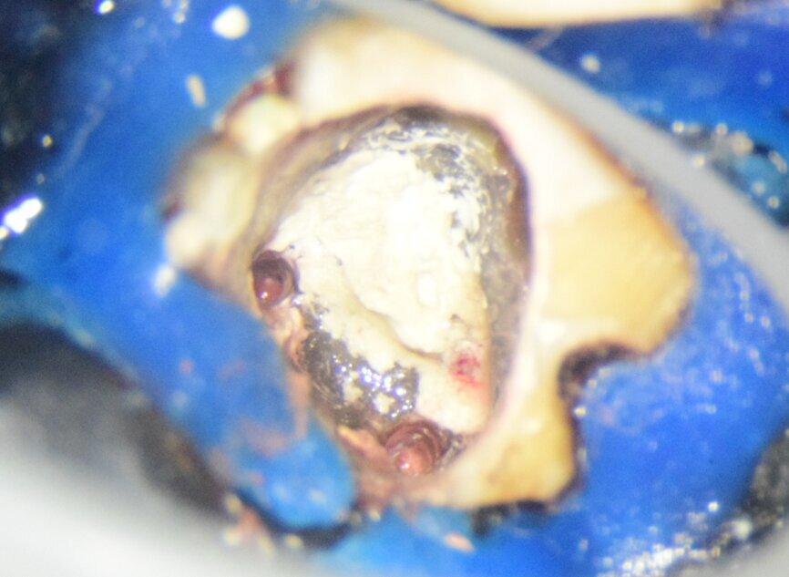 Fig. 5: Intra-op image of tooth #46 under the dental operating microscope at 16× magnification showing the sealed pulpal floor perforation with MTA and the obturated mesial canals with room for orifice plugs for the core material.