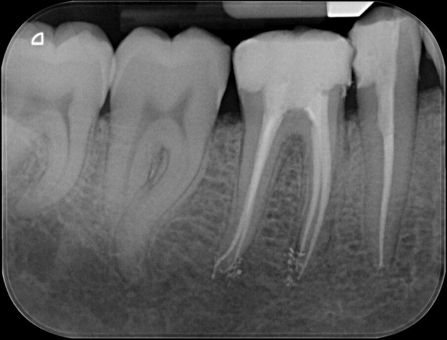 Afbeelding 5. De oorzaak van de pijn bij het kauwen: een opspelende laesie van endodontische origine (LEO) aan de mesio-buccale radix.