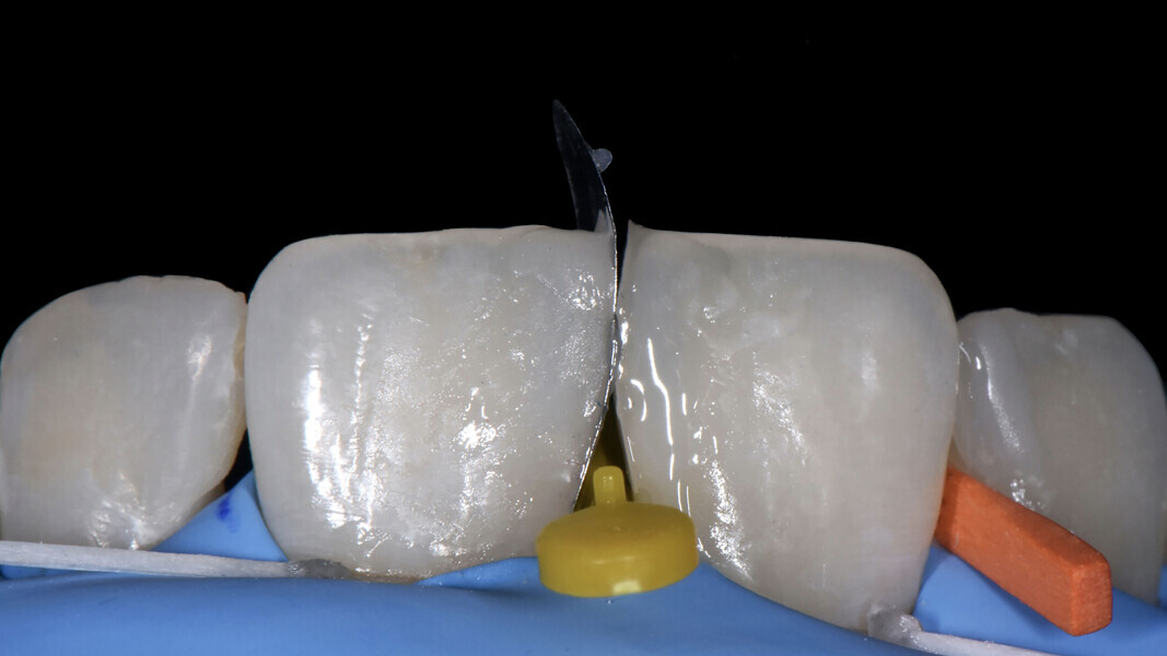 Fig. 11: Construction of the mesial wall of tooth #21.