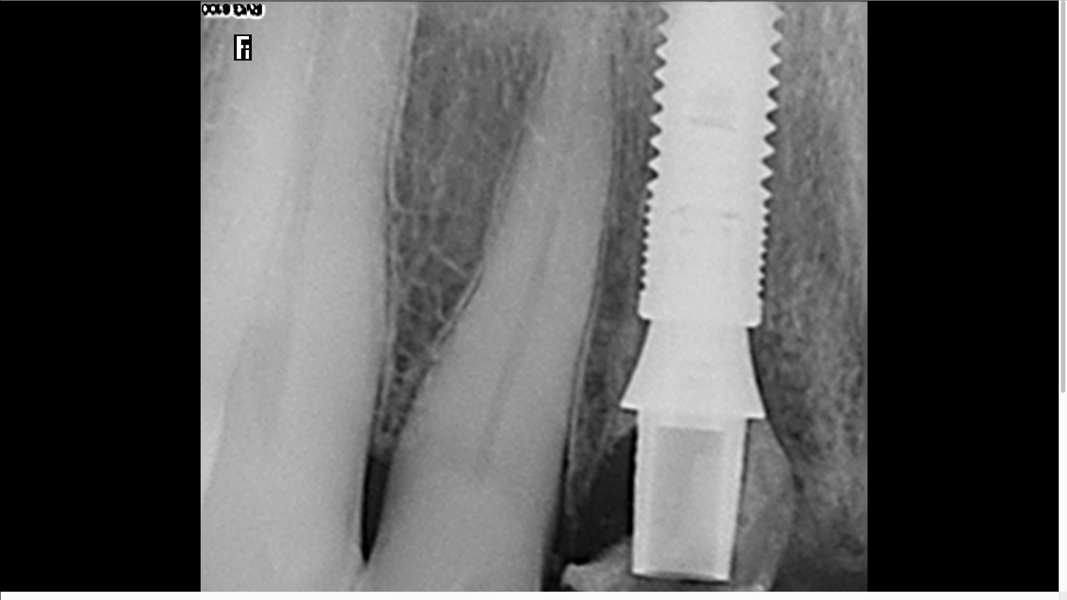 Fig. 17: Post-op radiograph after implant placement.