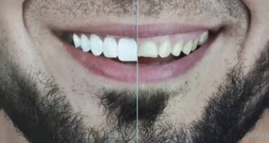 Rehabilitacija pacijenata sa sniženom VDO - prikaz slučaja