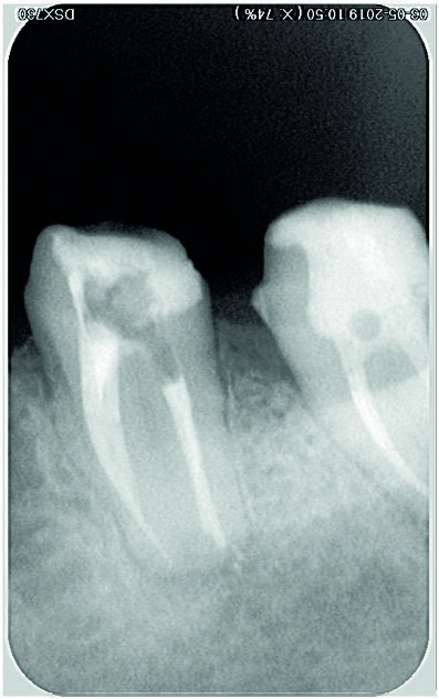 Figs. 15 et 16 : Radiographie après obturation. 