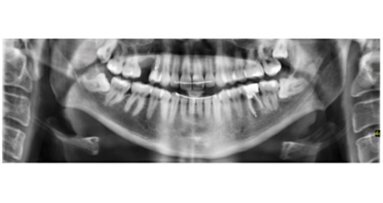 Retratamiento no quirúrgico de una periodontitis apical sintomática