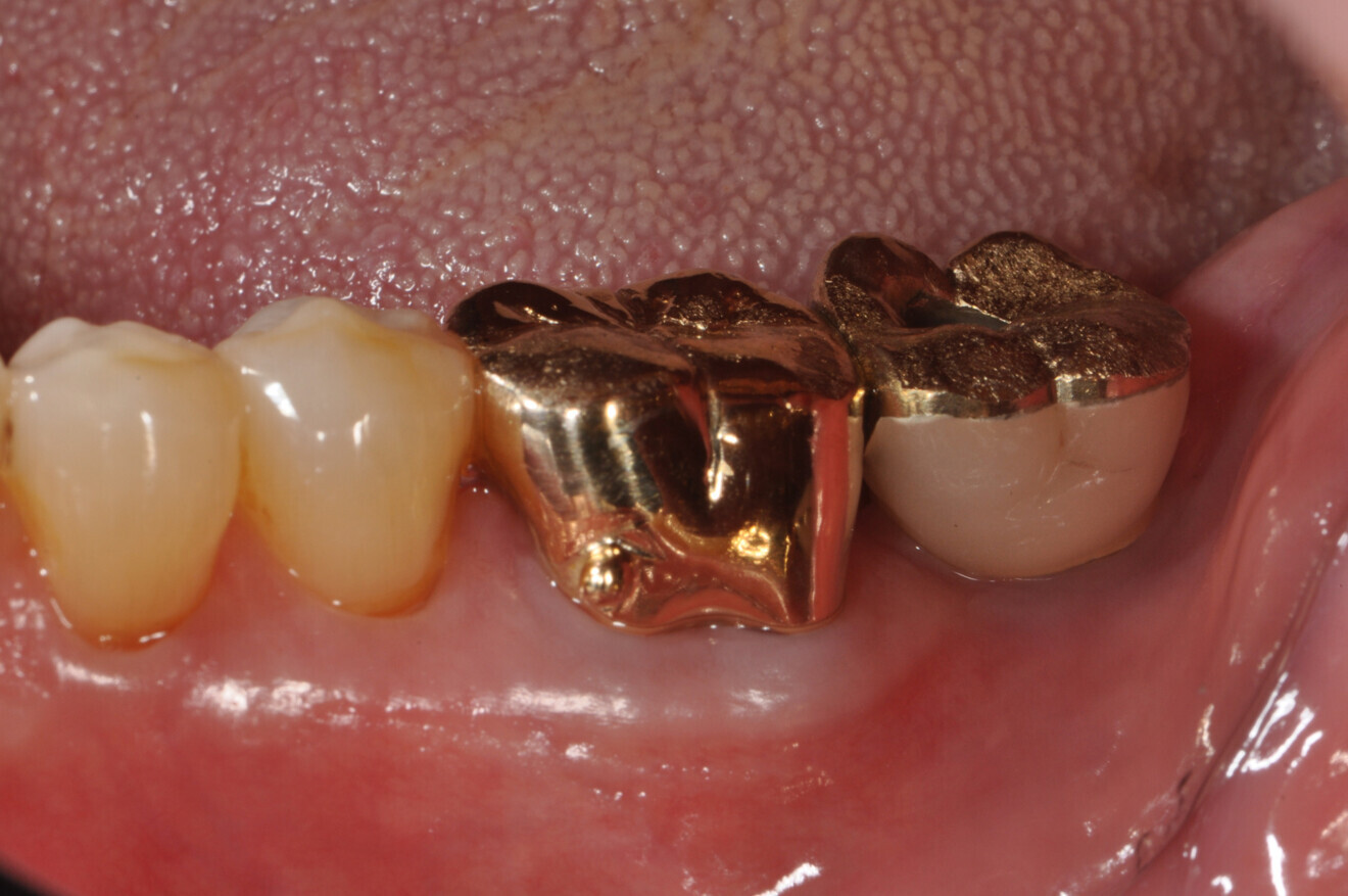 Stable gingiva observed six weeks after applying AIRFLOW on #47I.