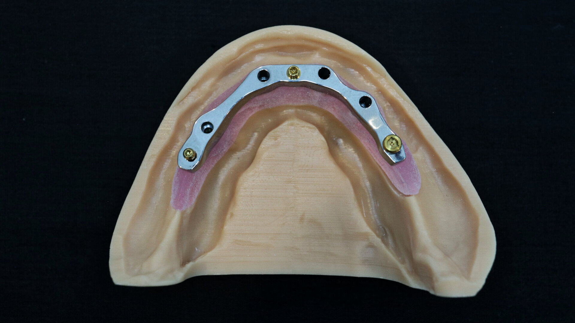 3D fabrication workflow: Solid and lattice-structured titanium alloy dental implant overdenture bars