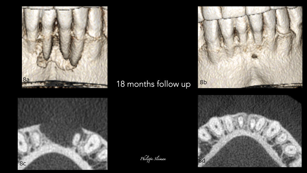 Figs. 8a–d: Comparison of the bone and horizontal views of the pre-op (a & b) and 18-month follow-up i-CAT scans (c & d) regarding the bone healing and the closure of the pocket.