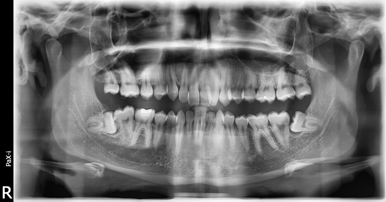 Fig. 3: Dental panoramic tomogram.