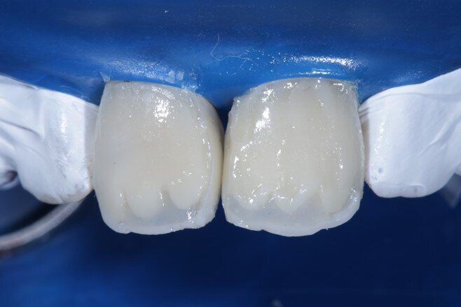 Fig 14 translucent shade placed in between mamelons