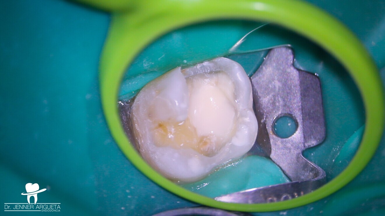 Fig. 6: Protection placed over the direct pulp capping material to speed up the restorative process, through the possibility of immediately applying the adhesive protocol.