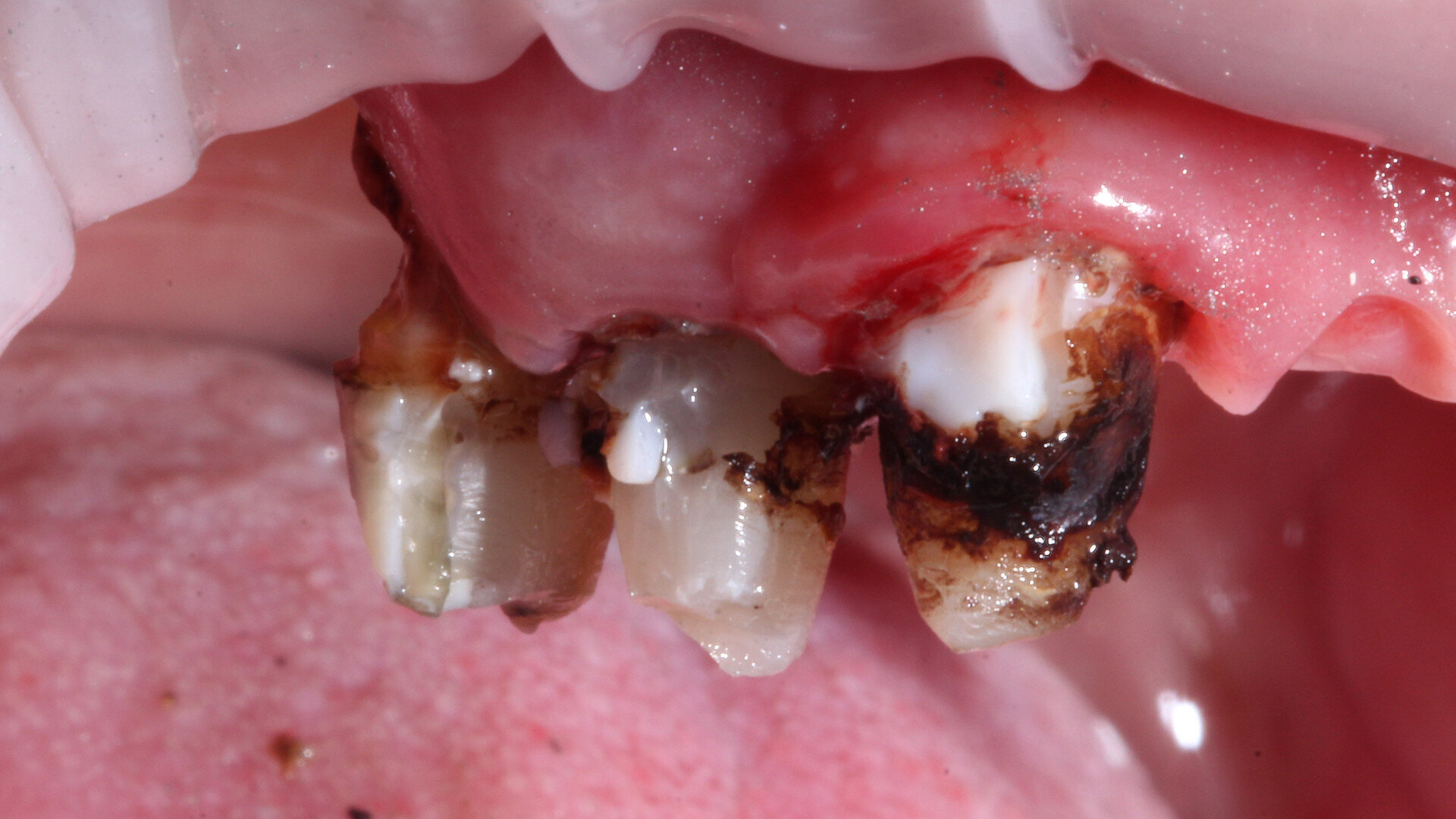 Comprehensive dental rehabilitation with a digital workflow: A case study