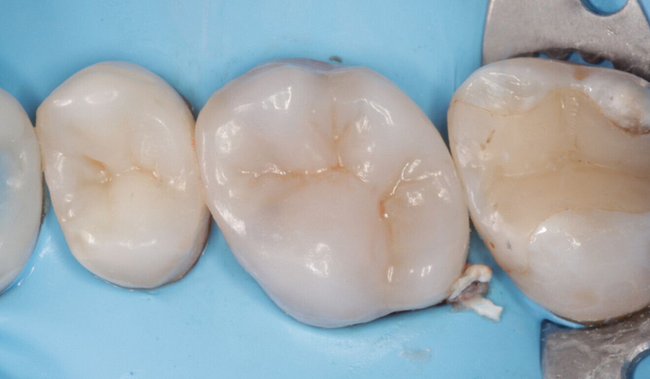 Fig. 16: Occlusal surface after surface modelling with CLEARFIL MAJESTY ES-2 Universal and initial polishing, occlusal view. (Image: Kuraray Noritake Dental)