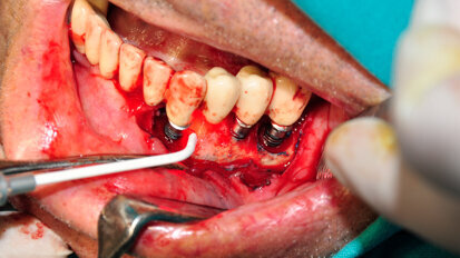 Photodynamic therapy: Indispensable adjunct for disinfecting immediate restorations