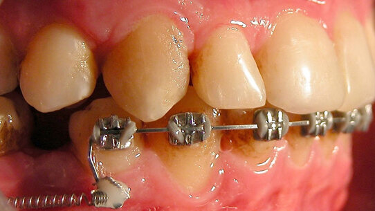 Extreme Smile Makeover: risoluzione clinico-estetica di una dismorfia facciale dento-scheletrica di classe III