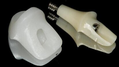 Implantology—the perfect art of camouflage thanks to CAD/CAM