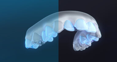 Align Technology predstavlja paket Invisalign Moderate, zdravljenje za korekcijo blage do zmerne malokluzije