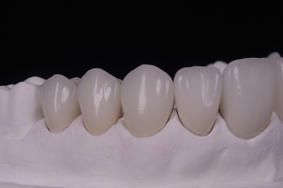 Fig. 13a–d: Final restorations on the model.