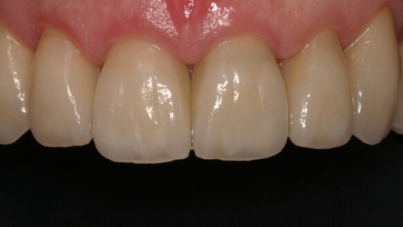 Using provisional restorations in complex restorative cases