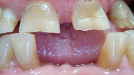 Treatment of drug-induced gingival enlargement with Er:YAG laser