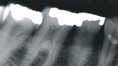 Les radiographies dentaires peuvent prédire les fractures