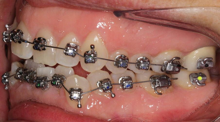 Initial treatment