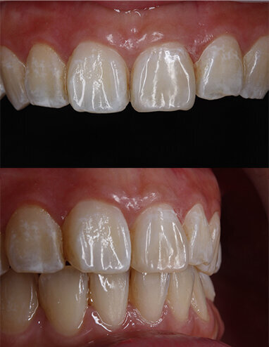 Fig 14a & 14b: 2 month post-op recall visit