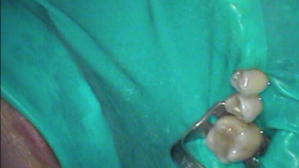 Le champ opératoire en endodontie (et ailleurs) : L’élément primordial du succès
