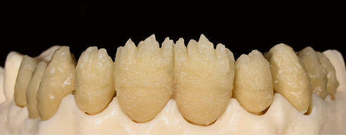 Fig. 8 & 9: The ceramic materials were mixed with Liquid Visual Eyes for the purpose of visually comparing the two materials during the layering proces (left: IPS d.SIGN; right: IPS Style)