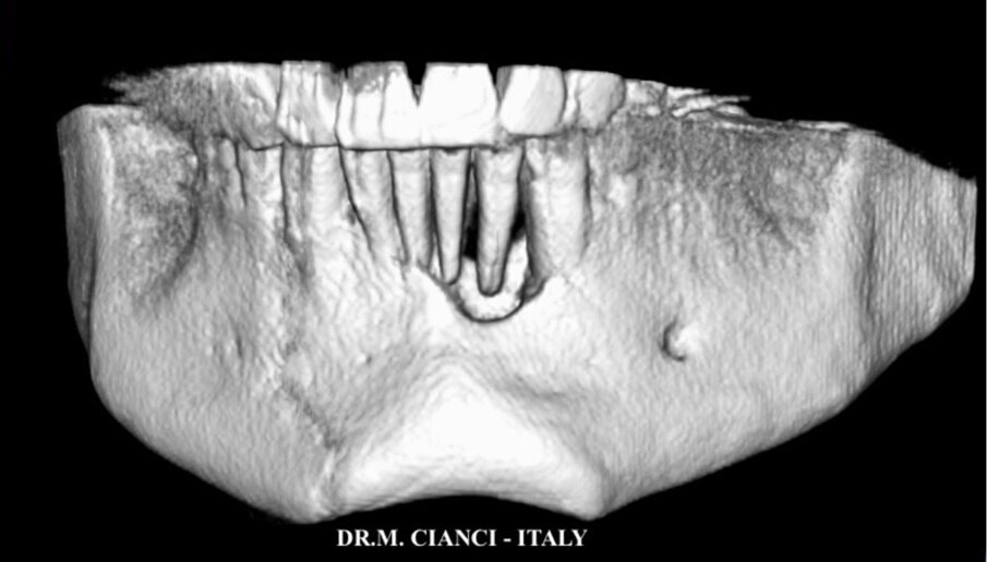 Fig. 2 - Immagine 3D della mandibola a un mese dalle avulsioni dentarie. 